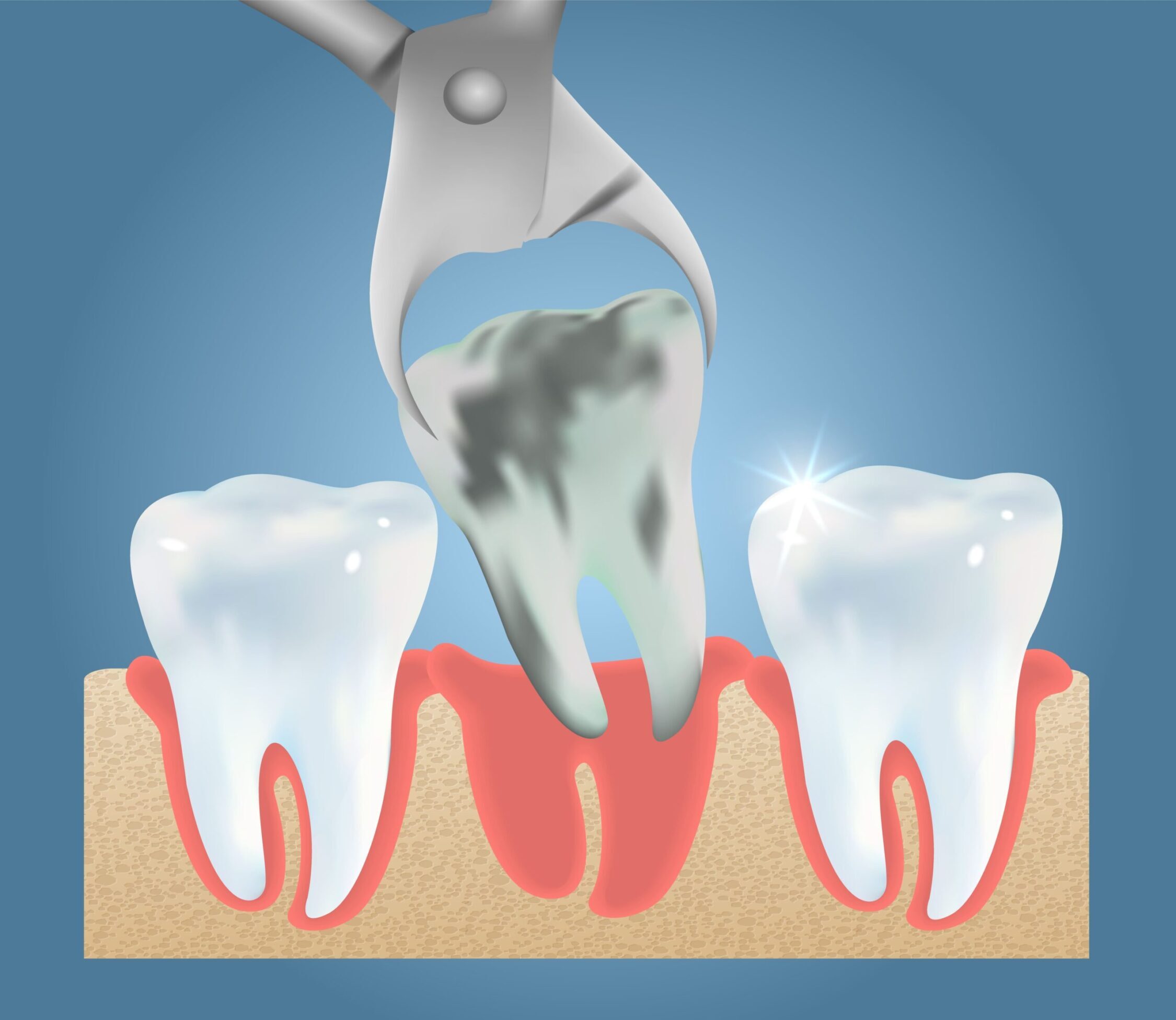 Tooth Extractions in Saskatoon