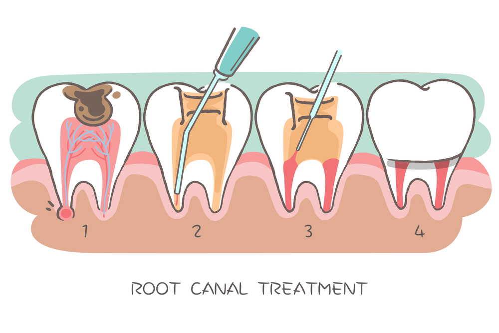 Root Canal Therapy in Saskatoon